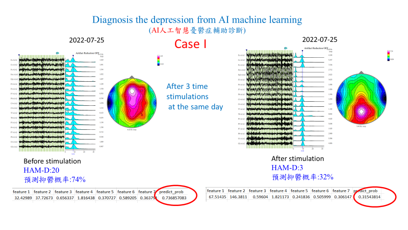本團隊合作案例之治療前後腦電波分佈比對圖